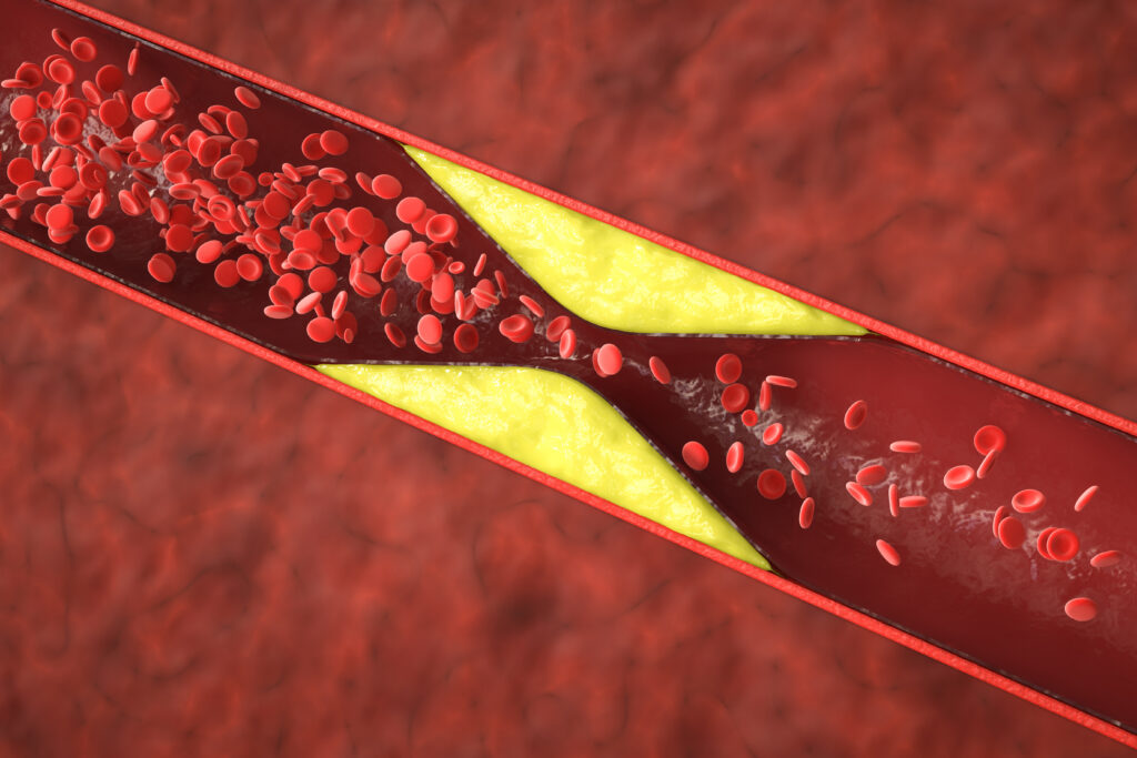 atherosclerosis with plaque in vessel - Dr.成井の毛髪LAB – AGA対策から植毛最新技術まで